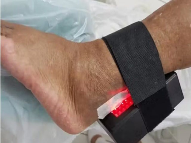 Inovação brasileira busca diminuir amputações causadas pelo diabetes