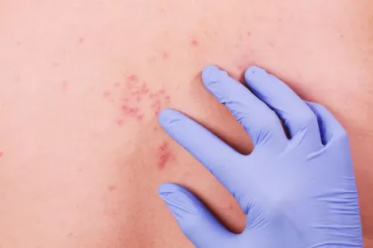 Saúde explica decisão de não incluir vacina contra herpes-zóster no SUS