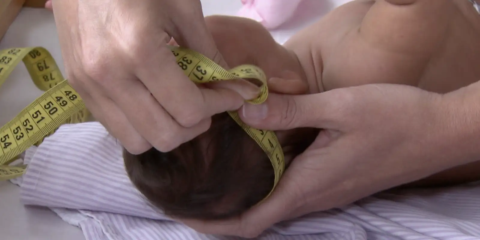 Estudo revela que mais de 20% das crianças com microcefalia causada pelo zika vírus apresentam má-formação após o nascimento