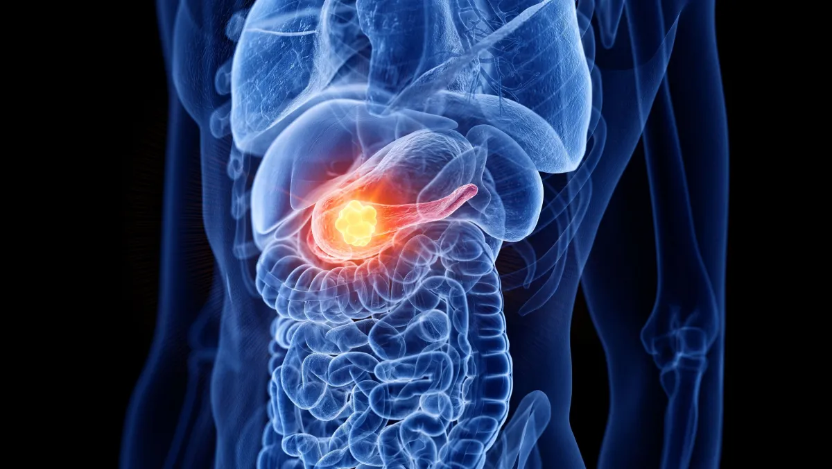 Pesquisa revela proteína que potencializa a propagação do câncer de pâncreas através dos nervos