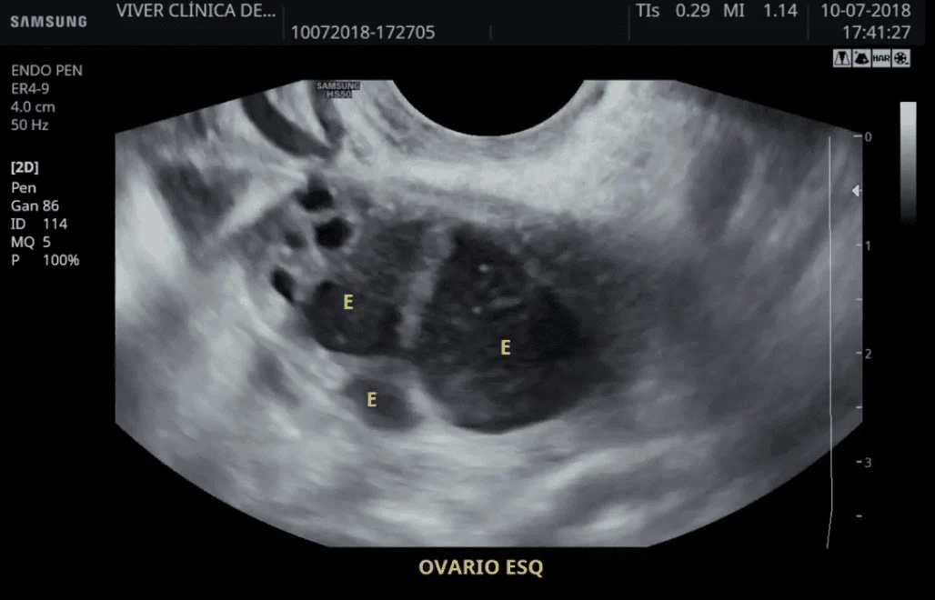 Endometriose: dor intensa pode ser sinal de doença crônica
