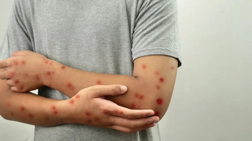 Ceará confirma terceiro caso de infecção por mpox em 2026